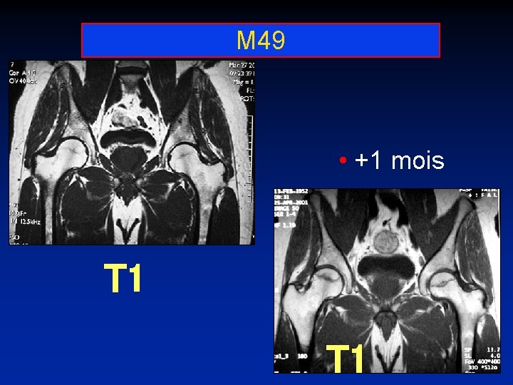 M 49 • +1 mois T 1 