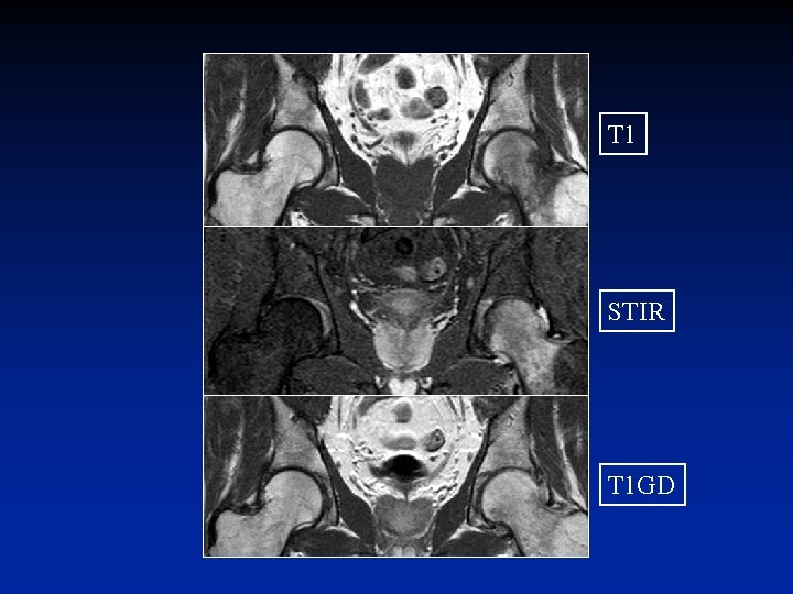 T 1 STIR T 1 GD 
