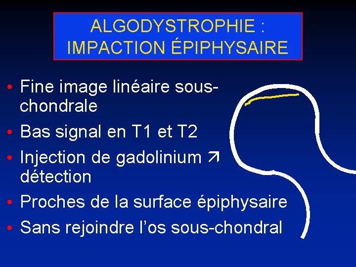 ALGODYSTROPHIE : IMPACTION ÉPIPHYSAIRE • Fine image linéaire souschondrale • Bas signal en T