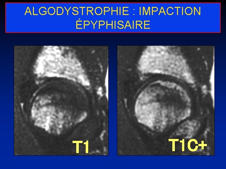ALGODYSTROPHIE : IMPACTION ÉPYPHISAIRE T 1 C+ 