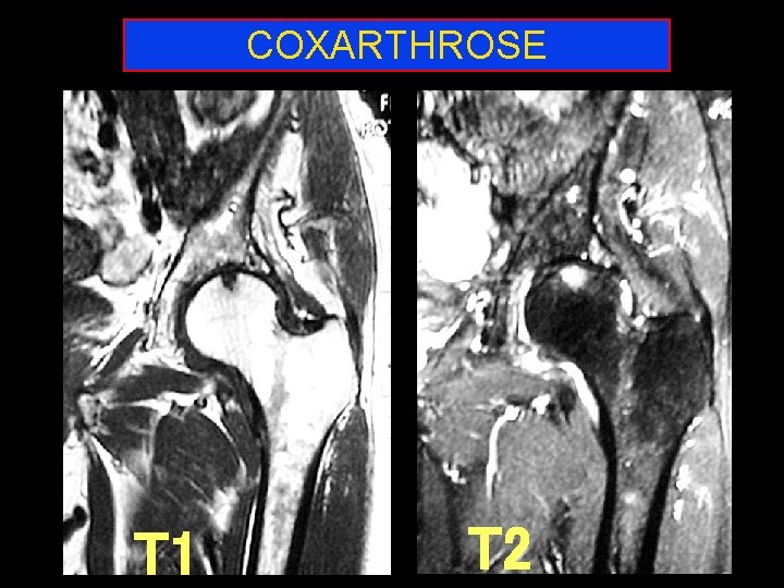 COXARTHROSE T 1 T 2 