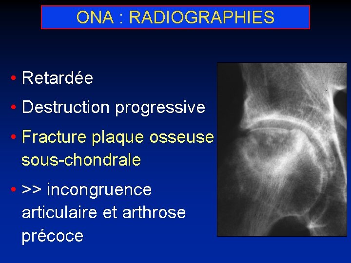 ONA : RADIOGRAPHIES • Retardée • Destruction progressive • Fracture plaque osseuse sous-chondrale •