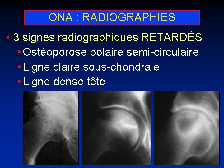 ONA : RADIOGRAPHIES • 3 signes radiographiques RETARDÉS • Ostéoporose polaire semi-circulaire • Ligne