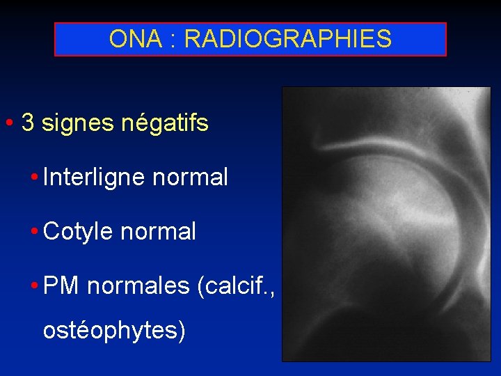 ONA : RADIOGRAPHIES • 3 signes négatifs • Interligne normal • Cotyle normal •