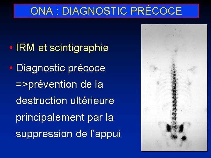 ONA : DIAGNOSTIC PRÉCOCE • IRM et scintigraphie • Diagnostic précoce =>prévention de la
