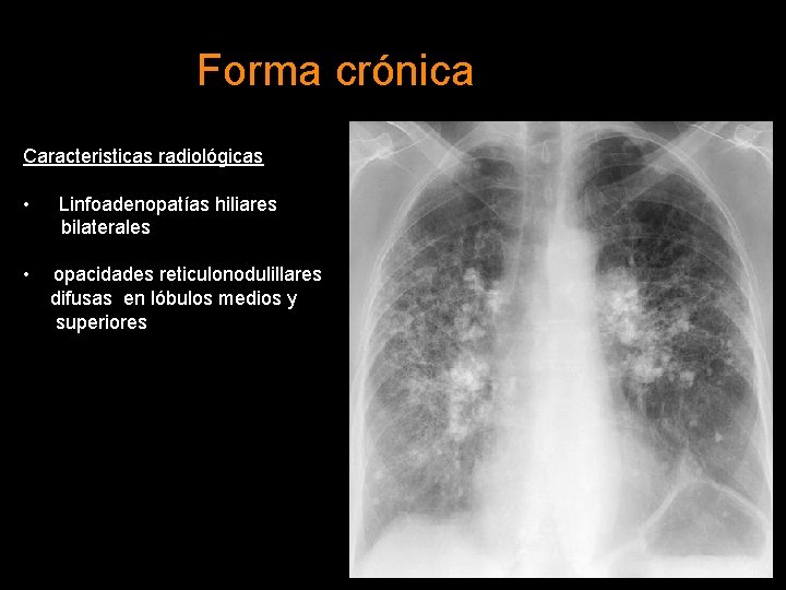 Forma crónica Caracteristicas radiológicas • • Linfoadenopatías hiliares bilaterales opacidades reticulonodulillares difusas en lóbulos