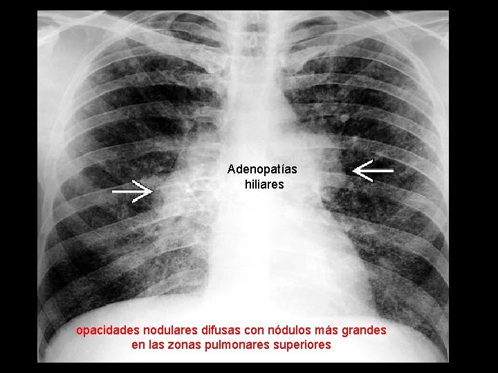 Adenopatías hiliares opacidades nodulares difusas con nódulos más grandes en las zonas pulmonares superiores