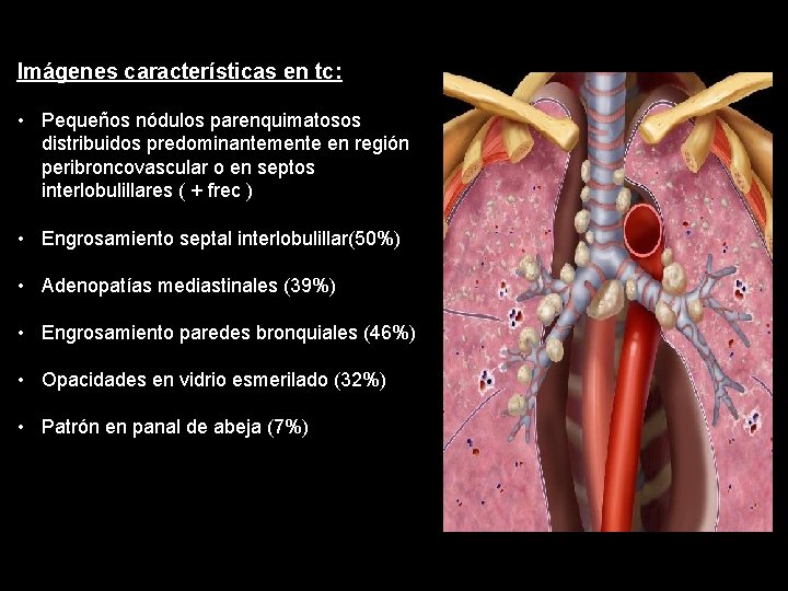 Imágenes características en tc: • Pequeños nódulos parenquimatosos distribuidos predominantemente en región peribroncovascular o