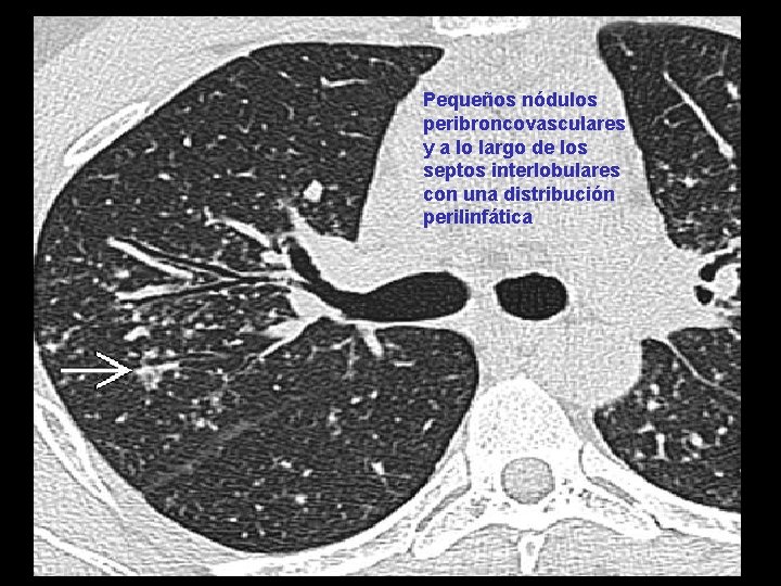 Pequeños nódulos peribroncovasculares y a lo largo de los septos interlobulares con una distribución