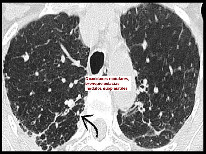 Opacidades nodulares, bronquiolectasias nódulos subpleurales 