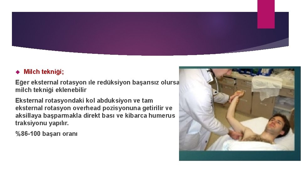  Milch tekniği; Eğer eksternal rotasyon ıle redüksiyon başarısız olursa milch tekniği eklenebilir Eksternal