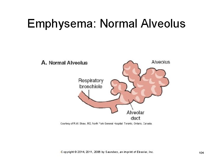 Emphysema: Normal Alveolus • Copyright © 2014, 2011, 2006 by Saunders, an imprint of