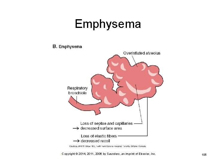 Emphysema • Copyright © 2014, 2011, 2006 by Saunders, an imprint of Elsevier, Inc.