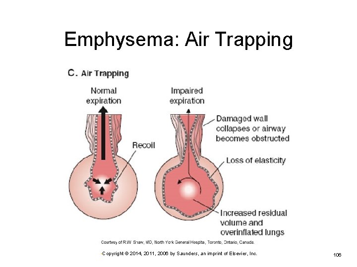 Emphysema: Air Trapping • Copyright © 2014, 2011, 2006 by Saunders, an imprint of