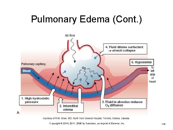 Pulmonary Edema (Cont. ) • Copyright © 2014, 2011, 2006 by Saunders, an imprint