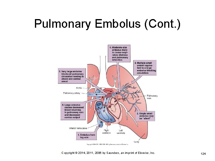 Pulmonary Embolus (Cont. ) • Copyright © 2014, 2011, 2006 by Saunders, an imprint