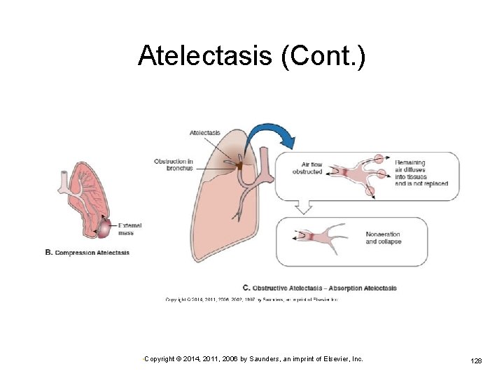 Atelectasis (Cont. ) • Copyright © 2014, 2011, 2006 by Saunders, an imprint of