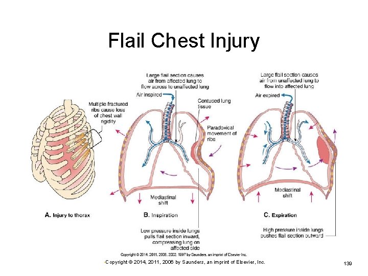 Flail Chest Injury • Copyright © 2014, 2011, 2006 by Saunders, an imprint of
