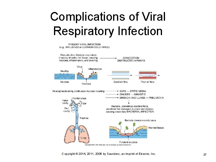 Complications of Viral Respiratory Infection • Copyright © 2014, 2011, 2006 by Saunders, an