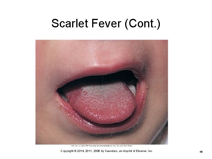 Scarlet Fever (Cont. ) • Copyright © 2014, 2011, 2006 by Saunders, an imprint