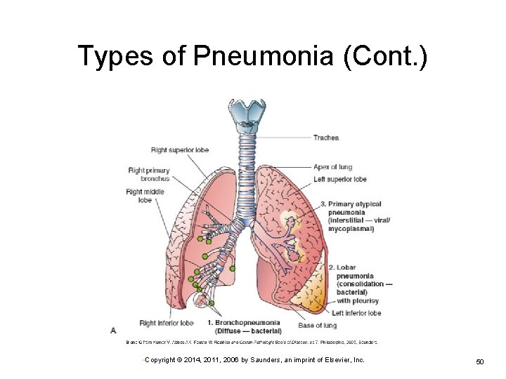 Types of Pneumonia (Cont. ) • Copyright © 2014, 2011, 2006 by Saunders, an