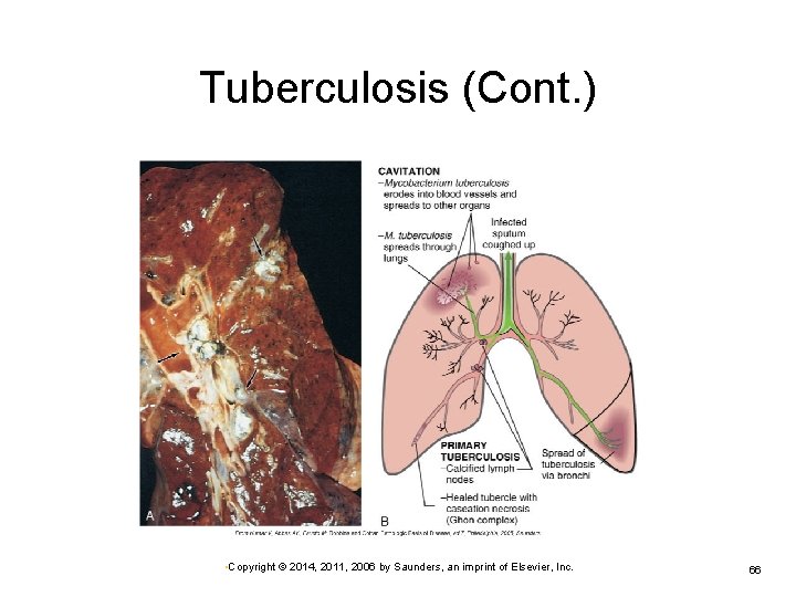 Tuberculosis (Cont. ) • Copyright © 2014, 2011, 2006 by Saunders, an imprint of
