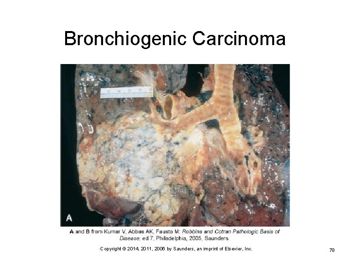 Bronchiogenic Carcinoma • Copyright © 2014, 2011, 2006 by Saunders, an imprint of Elsevier,