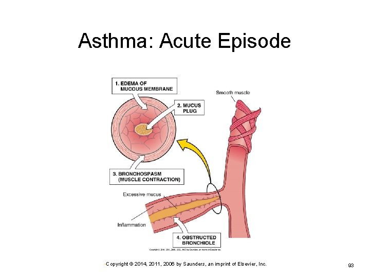 Asthma: Acute Episode • Copyright © 2014, 2011, 2006 by Saunders, an imprint of