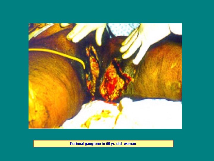 Perineal gangrene in 60 yr. old woman 