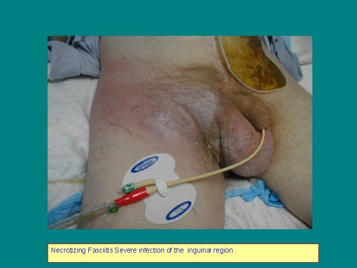 Necrotizing Fasciitis Severe infection of the inguinal region. 