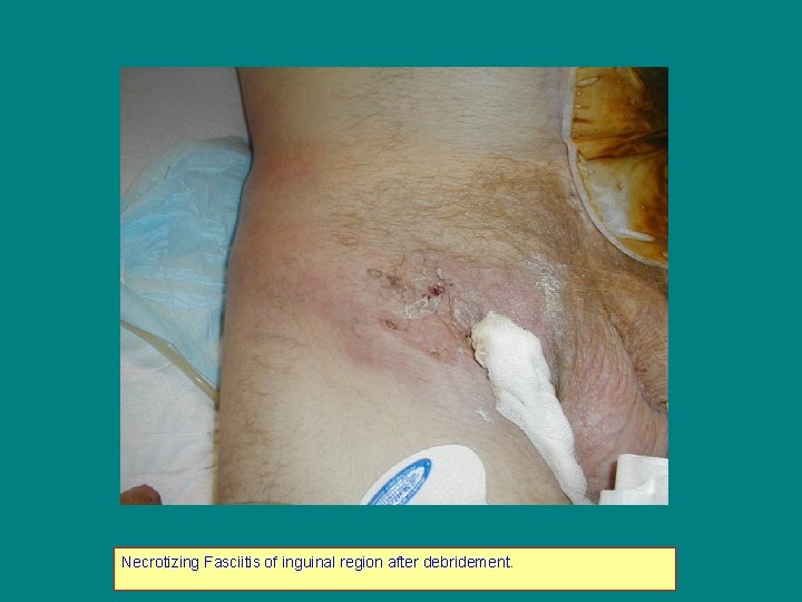 Necrotizing Fasciitis of inguinal region after debridement. 