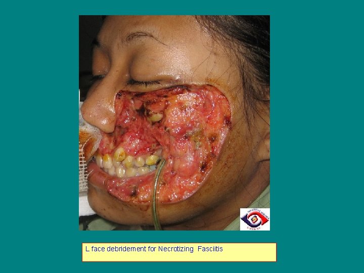 L face debridement for Necrotizing Fasciitis 