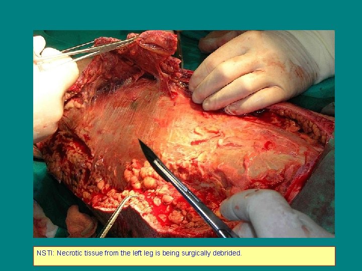 NSTI: Necrotic tissue from the left leg is being surgically debrided. 