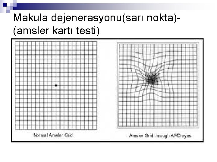 Makula dejenerasyonu(sarı nokta)(amsler kartı testi) 