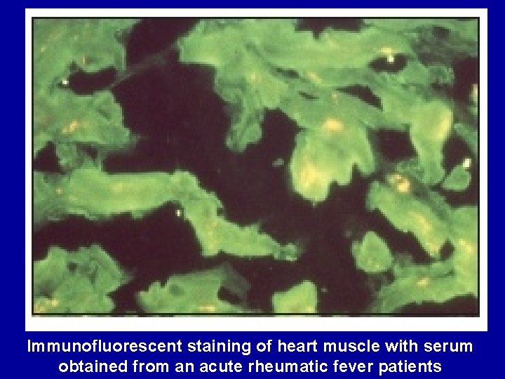 Immunofluorescent staining of heart muscle with serum obtained from an acute rheumatic fever patients