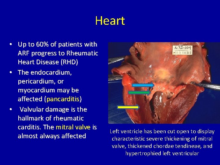Heart • Up to 60% of patients with ARF progress to Rheumatic Heart Disease