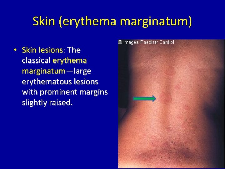 Skin (erythema marginatum) • Skin lesions: The classical erythema marginatum—large erythematous lesions with prominent