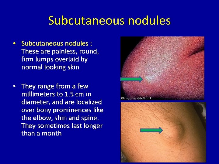 Subcutaneous nodules • Subcutaneous nodules : These are painless, round, firm lumps overlaid by