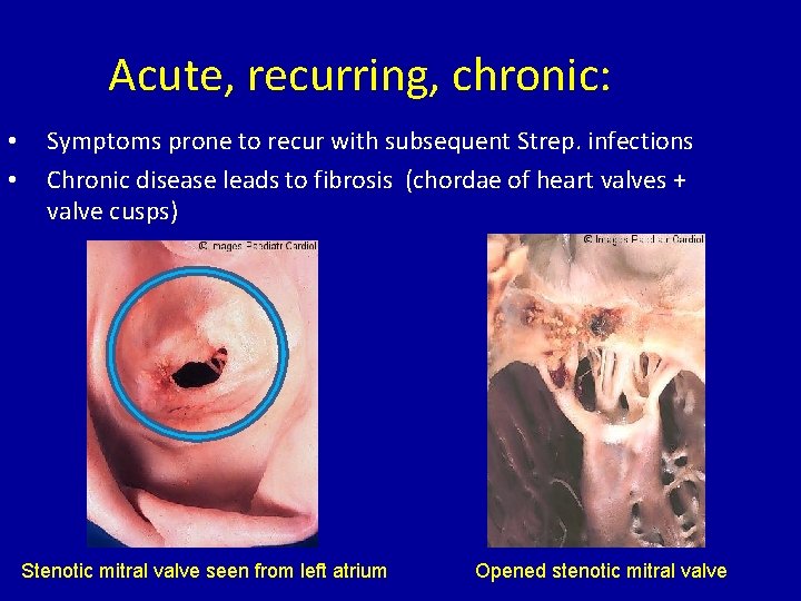 Acute, recurring, chronic: • • Symptoms prone to recur with subsequent Strep. infections Chronic