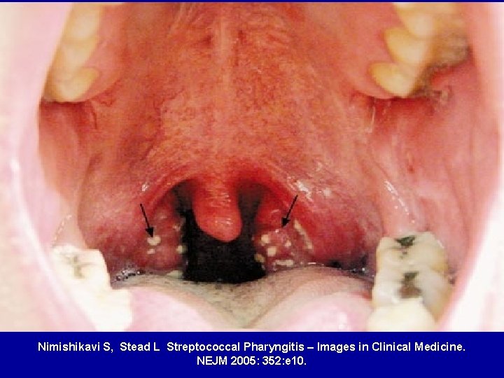 Nimishikavi S, Stead L Streptococcal Pharyngitis – Images in Clinical Medicine. NEJM 2005: 352: