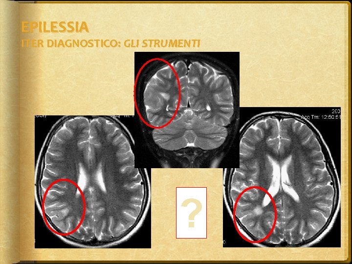 EPILESSIA ITER DIAGNOSTICO: GLI STRUMENTI ? 