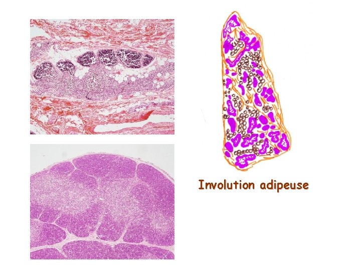 Involution adipeuse 