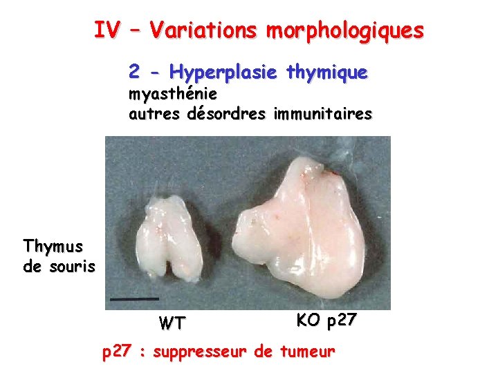 IV – Variations morphologiques 2 - Hyperplasie thymique myasthénie autres désordres immunitaires Thymus de