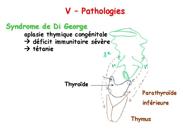 V – Pathologies Syndrome de Di George aplasie thymique congénitale déficit immunitaire sévère tétanie