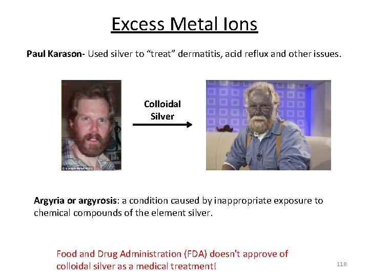 Excess Metal Ions Paul Karason‐ Used silver to “treat” dermatitis, acid reflux and other