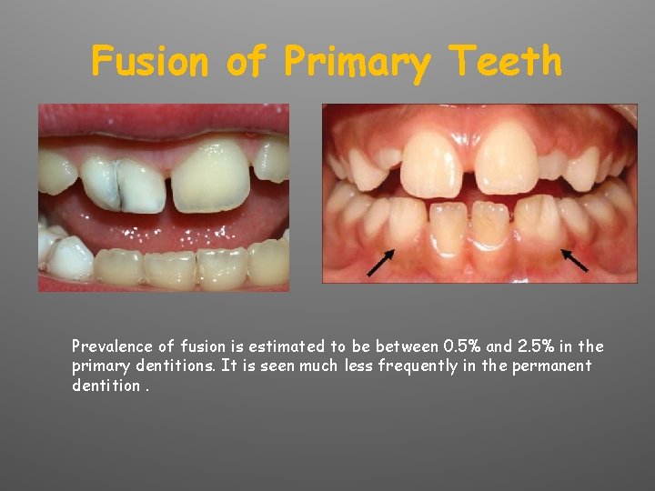Fusion of Primary Teeth Prevalence of fusion is estimated to be between 0. 5%