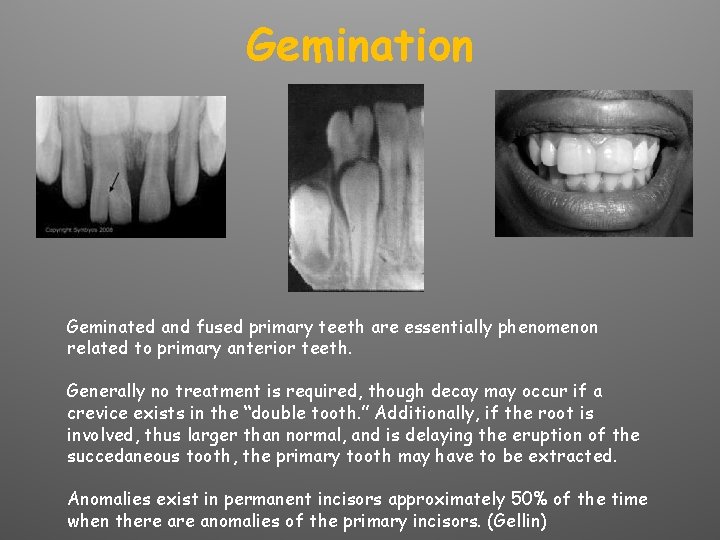 Gemination Geminated and fused primary teeth are essentially phenomenon related to primary anterior teeth.