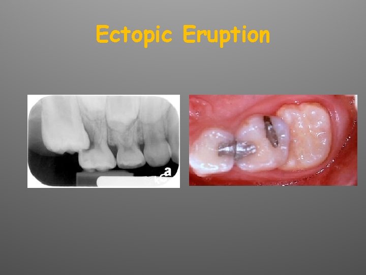 Ectopic Eruption 