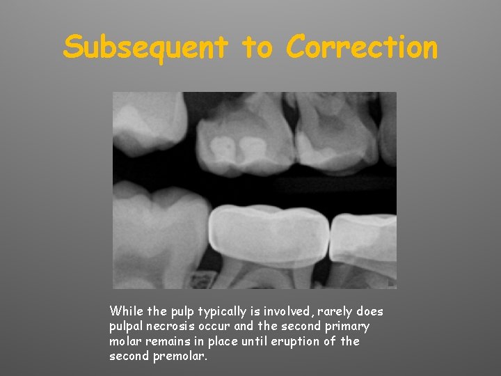 Subsequent to Correction While the pulp typically is involved, rarely does pulpal necrosis occur