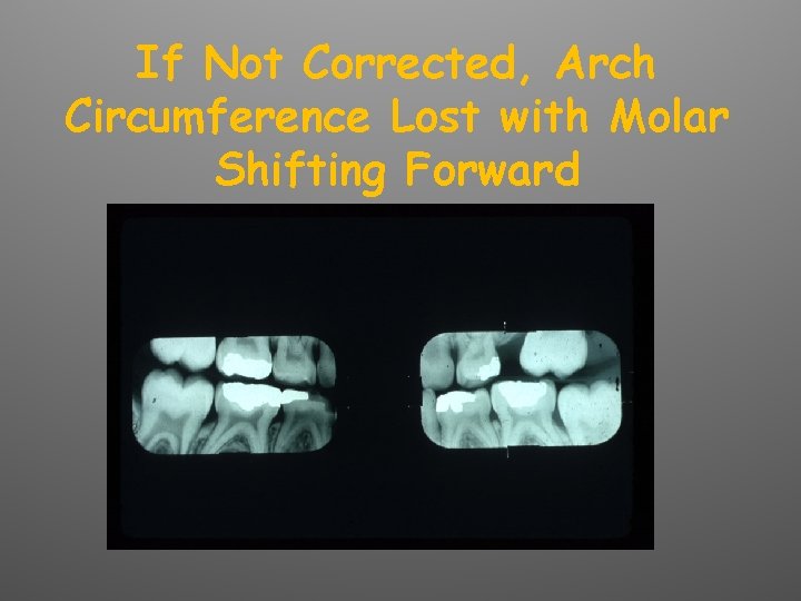 If Not Corrected, Arch Circumference Lost with Molar Shifting Forward 